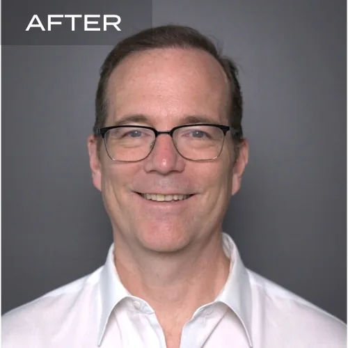 Before and after hair transplant results