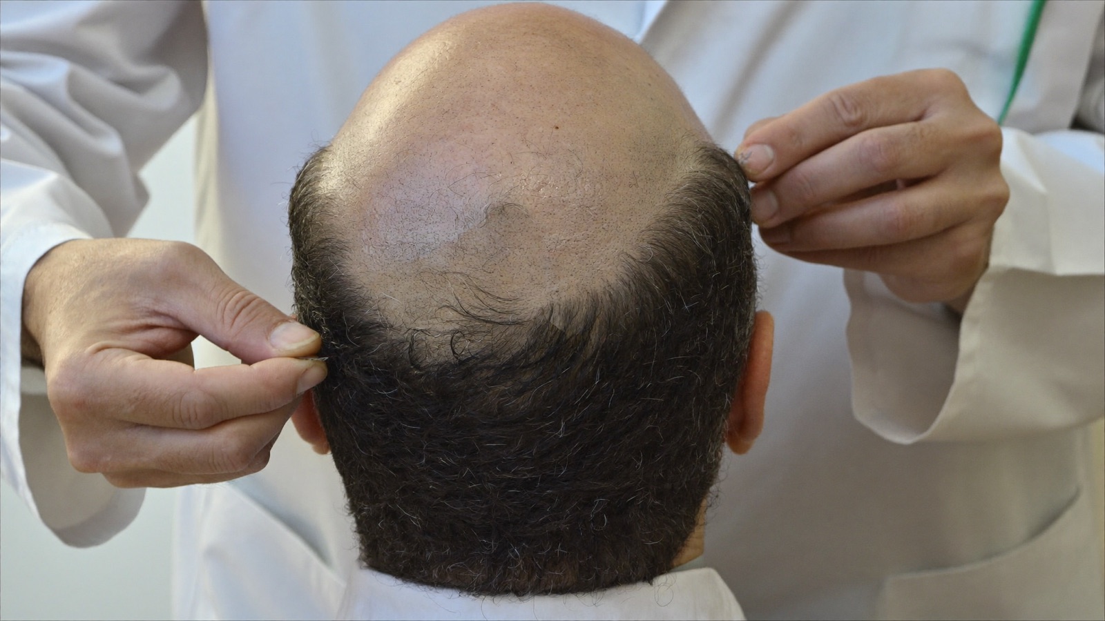 Clinician examining the dense band of hair at the back and sides of a bald patient's head