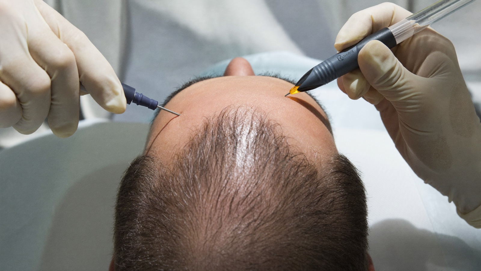Gloved hands holding two fine handheld instruments above the scalp of a patient during a hair transplant procedure