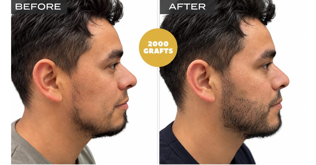 Toronto hair transplant before and after: beard transplant filling the cheek and jawline with 2,000 FUE grafts, side view, Nova Medical Toronto