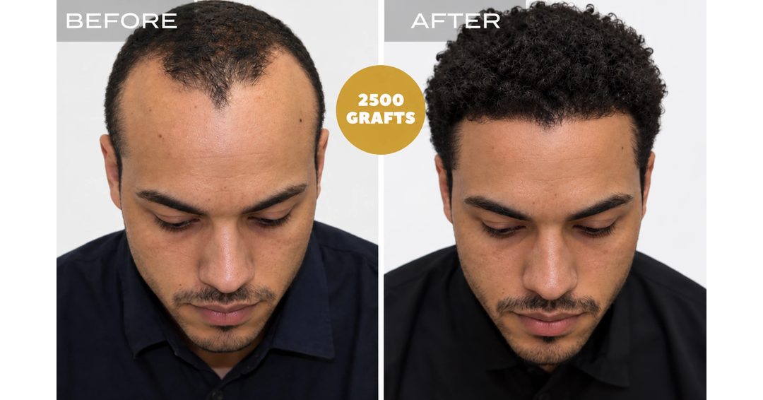 Toronto hair transplant before and after: curly hair hairline and density restoration with 2,500 FUE grafts, Nova Medical Toronto