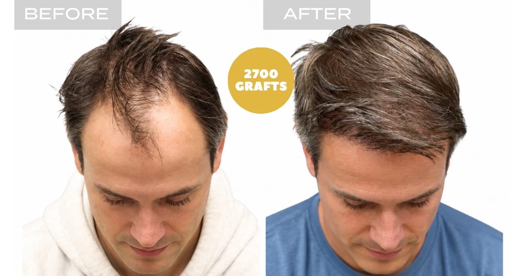 Toronto hair transplant before and after: receding hairline and frontal density restoration with 2,700 FUE grafts, Nova Medical Toronto