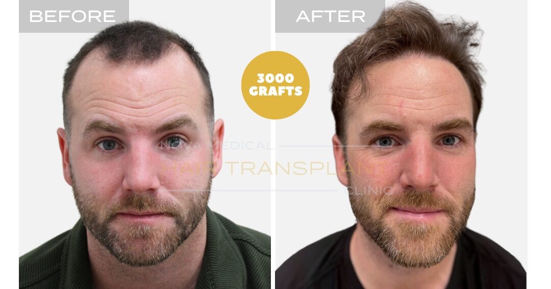 Hair Transplant Before & After Result 4 - HAIRLINE RESTORATION + DENSITY FILLING. MANUAL FUE 3000 GRAFTS., Nova Medical Toronto