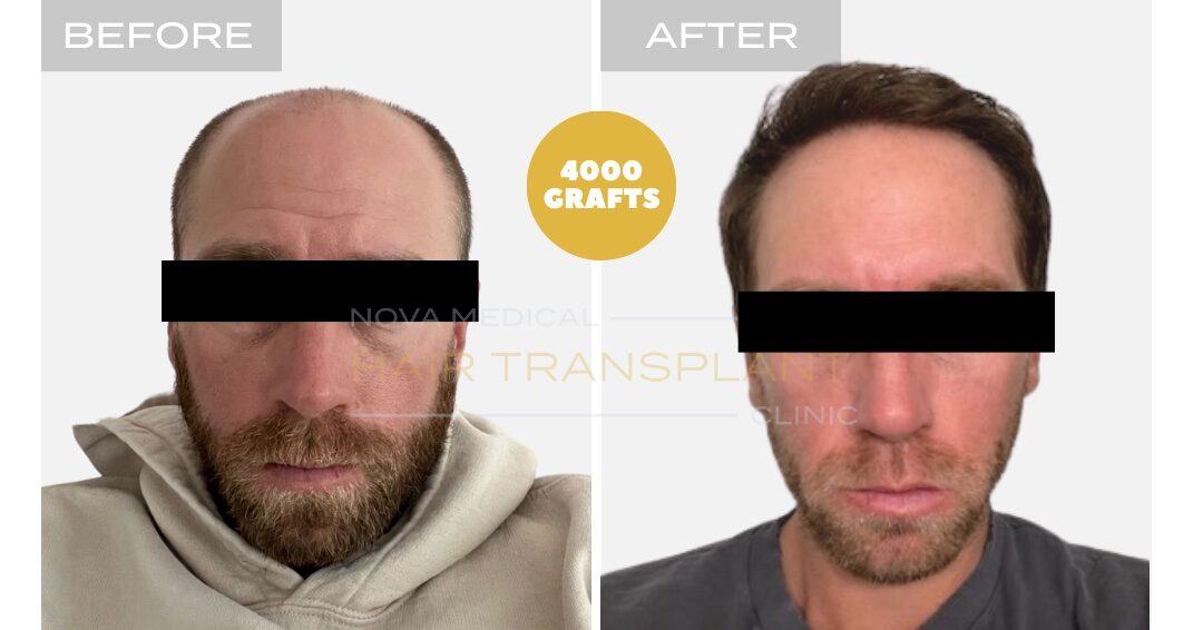 Hair Transplant Before & After Result 5 - HAIRLINE FORMATION + CROWN DENSITY RESTORATION. MANUAL FUE 4000 GRAFTS + DHI., Nova Medical Toronto