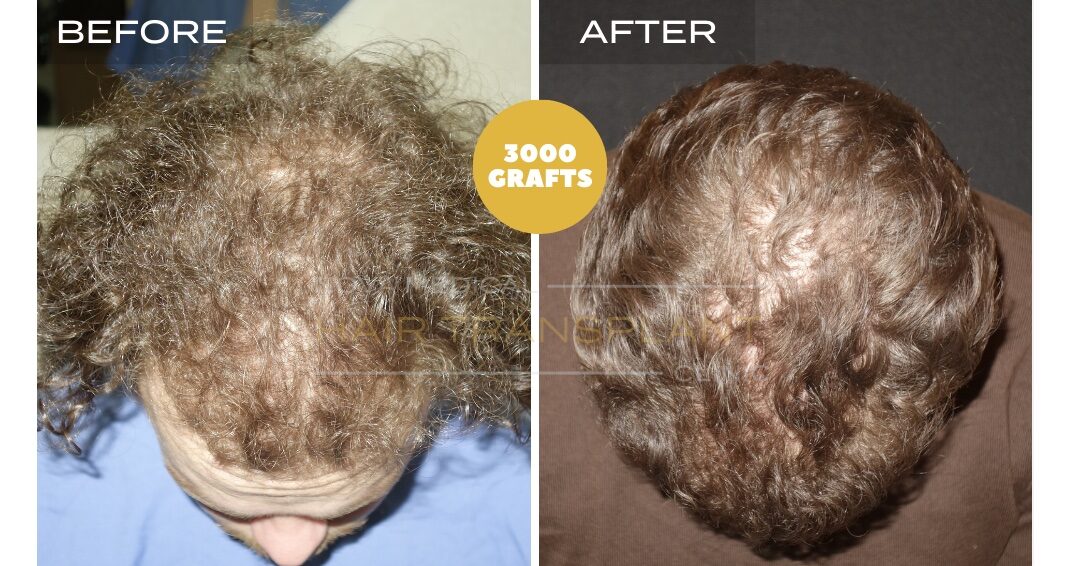 Hair Transplant Before & After Result 6 - FOR CURLY HAIR. DENSITY FILLING. SHAVELESS MANUAL FUE 3000 GRAFTS, Nova Medical Toronto