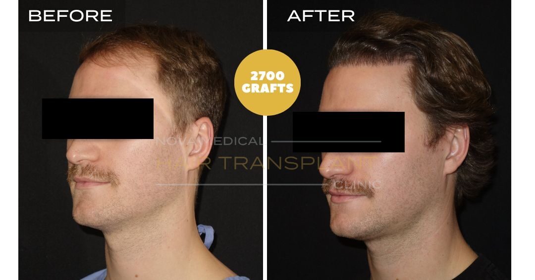 Hair Transplant Before & After Result 7 - HAIRLINE + DENSITY RESTORATION. MANUAL FUE 2700 GRAFTS., Nova Medical Toronto