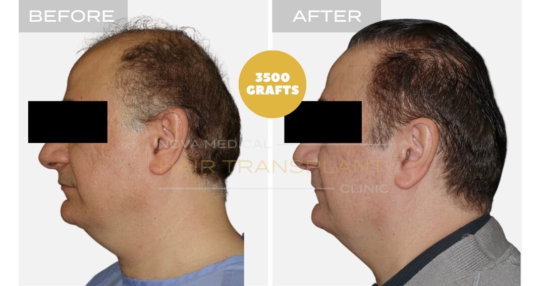 Hair Transplant Before & After Result 8 - HAIRLINE FORMATION + CROWN DENSITY RESTORATION. MANUAL FUE 3500 GRAFTS., Nova Medical Toronto
