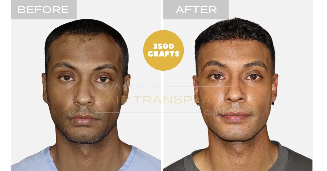 Hair Transplant Before & After Result 9 - THICK HAIR HAIRLINE RESTORATION. MANUAL FUE 3500 GRAFTS., Nova Medical Toronto