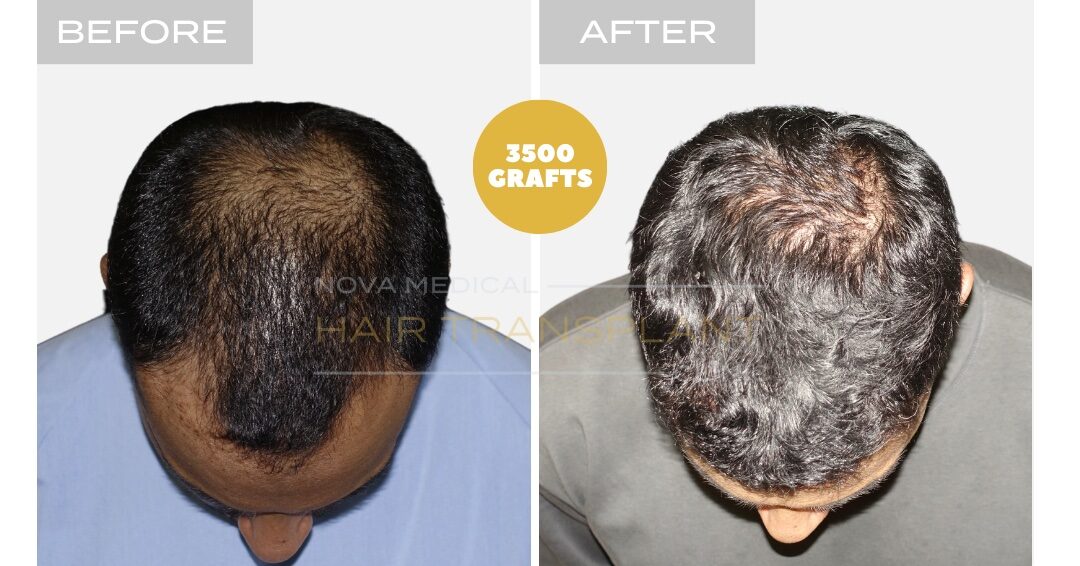 Hair Transplant Before & After Result 10 - THICK HAIR HAIRLINE RESTORATION. MANUAL FUE 3500 GRAFTS., Nova Medical Toronto