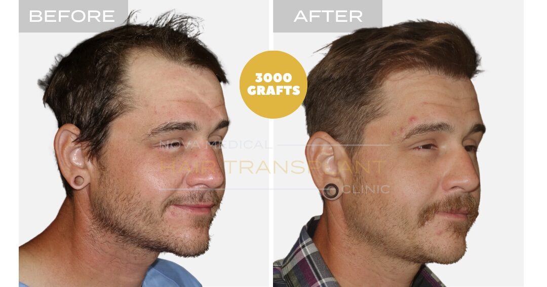 Hair Transplant Before & After Result 11 - HIGH DENSITY HAIRLINE RESTORATION. MANUAL FUE 3000 GRAFTS., Nova Medical Toronto