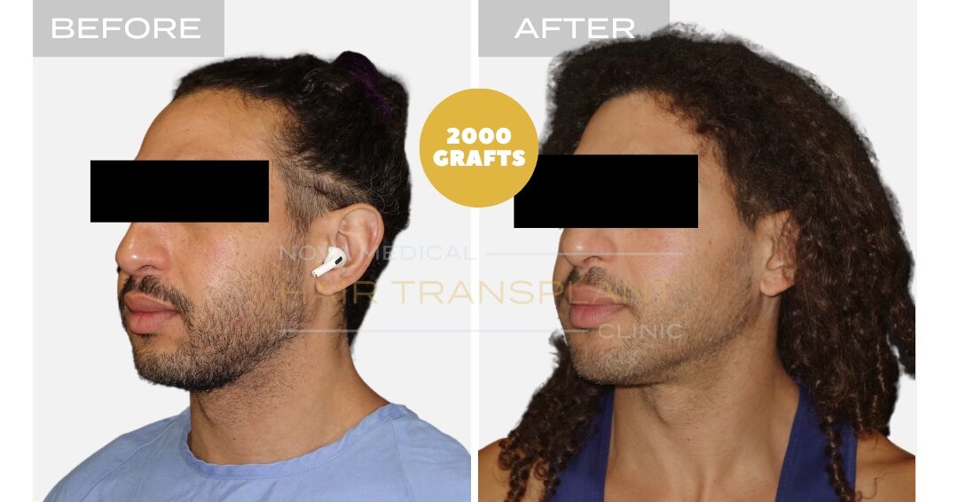 Hair Transplant Before & After Result 12 - NON-SHAVE CURLY HAIRLINE RESTORATION. MANUAL FUE 2000 GRAFTS., Nova Medical Toronto