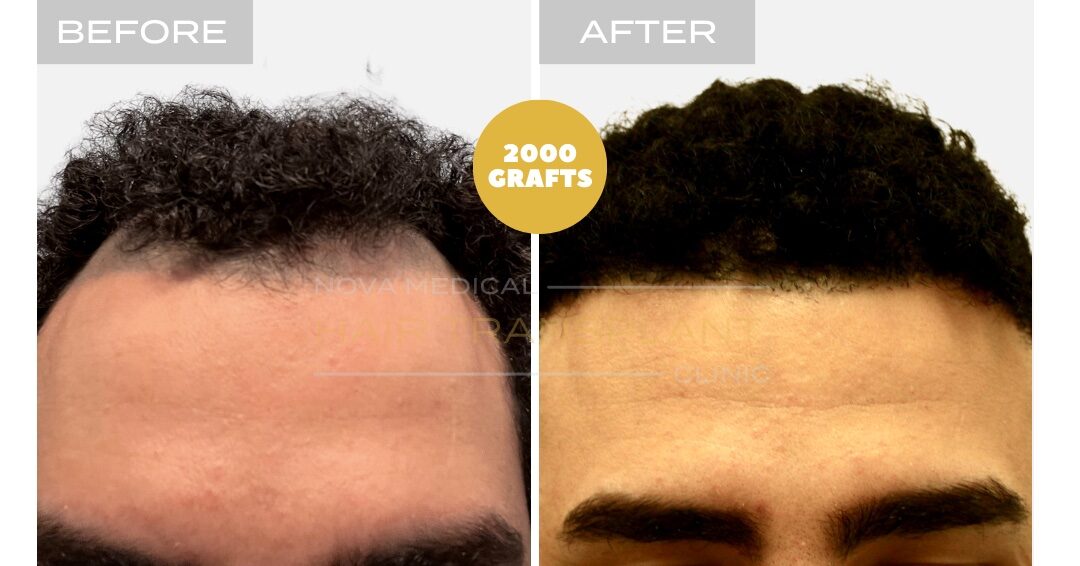 Hair Transplant Before & After Result 13 - HAIRLINE RESTORATION + DENSITY FILLING. MANUAL FUE 3000 GRAFTS., Nova Medical Toronto
