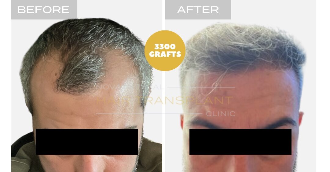Hair Transplant Before & After Result 14 - HAIRLINE + FRONTAL DENSITY RESTORATION. MANUAL FUE 3000 GRAFTS., Nova Medical Toronto