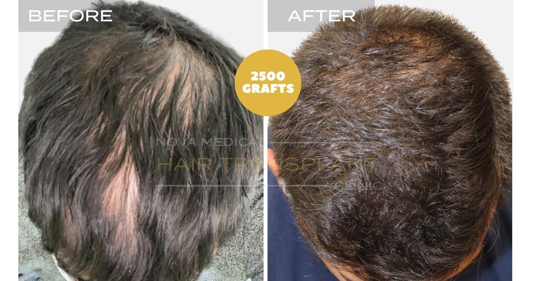 Hair Transplant Before & After Result 15 - HAIRLINE + CROWN DENSITTY RESTORATION. MANUAL FUE 3000 GRAFTS., Nova Medical Toronto