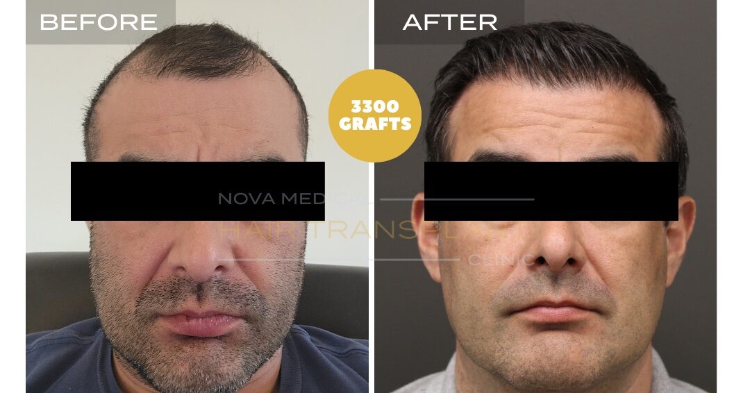 Hair Transplant Before & After Result 16 - HAIRLINE + FRONTAL DENSITY RESTORATION. MANUAL FUE + DHI 3300 GRAFTS., Nova Medical Toronto