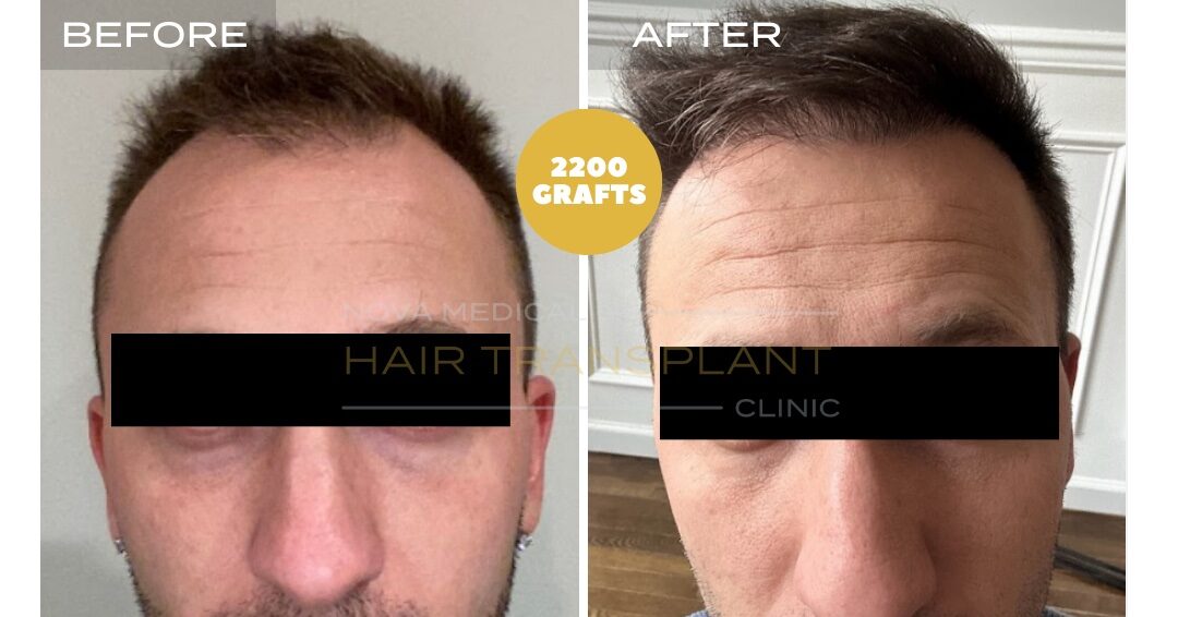 Hair Transplant Before & After Result 17 - HAIRLINE + CROWN DENSITY FILLING. MANUAL FUE 2200 GRAFTS., Nova Medical Toronto
