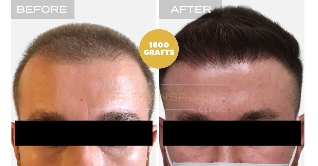 Hair Transplant Before & After Result 18 - HAIRLINE RESTORATION TOUCHUP. MANUAL FUE 1600 GRAFTS., Nova Medical Toronto
