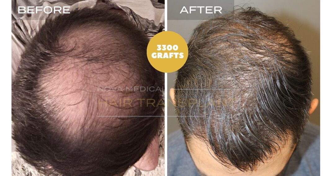 Hair Transplant Before & After Result 19 - CROWN + HAIRLINE RESTORATION. MANUAL FUE 3300 GRAFTS., Nova Medical Toronto