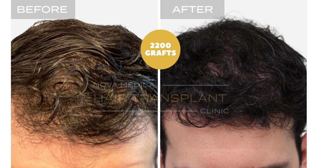 Hair Transplant Before & After Result 21 - HAIRLINE + DENSITY RESTORATION. MANUAL FUE 2200 GRAFTS., Nova Medical Toronto