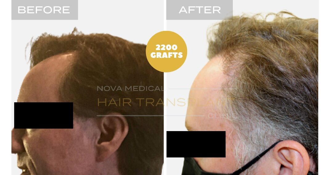 Hair Transplant Before & After Result 22 - TEMPLE FILLING + HAIRLINE RESTORATION. MANUAL FUE 2200 GRAFTS., Nova Medical Toronto