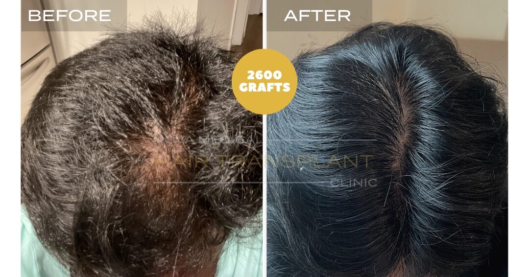 Hair Transplant Before & After Result 23 - CROWN DENSITY RESTORATION. MANUAL FUE 2600 GRAFTS., Nova Medical Toronto