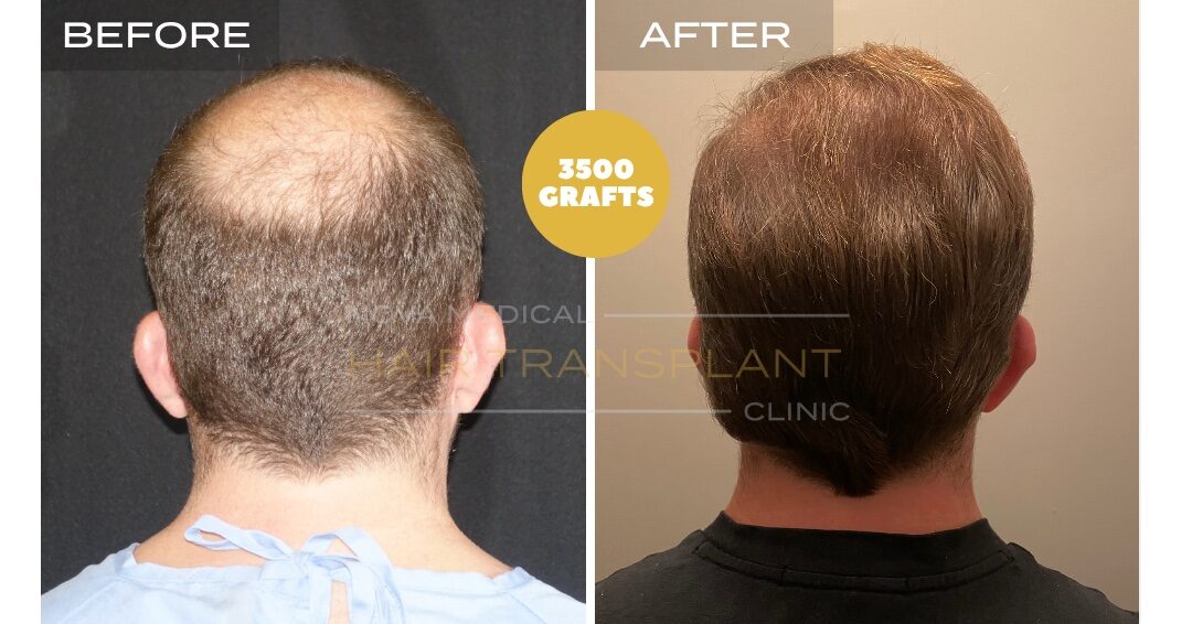 Hair Transplant Before & After Result 24 - CROWN DENSITY RESTORATION. MANUAL FUE 3500 GRAFTS., Nova Medical Toronto