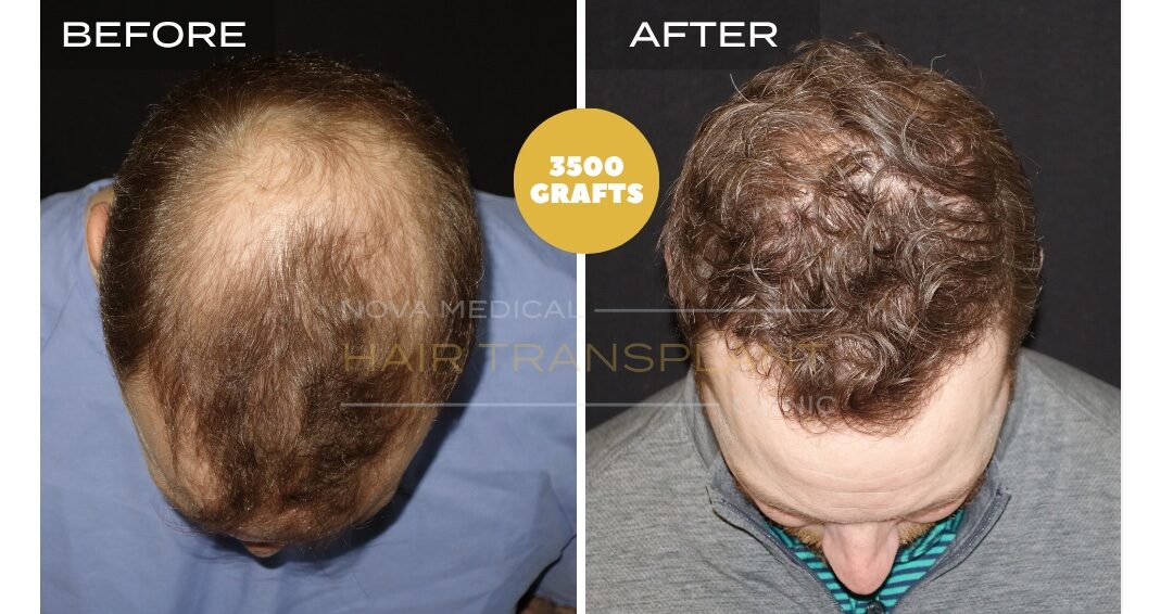 Hair Transplant Before & After Result 25 - CROWN + HAIRLINE RESTORATION. MANUAL FUE 3500 GRAFTS., Nova Medical Toronto