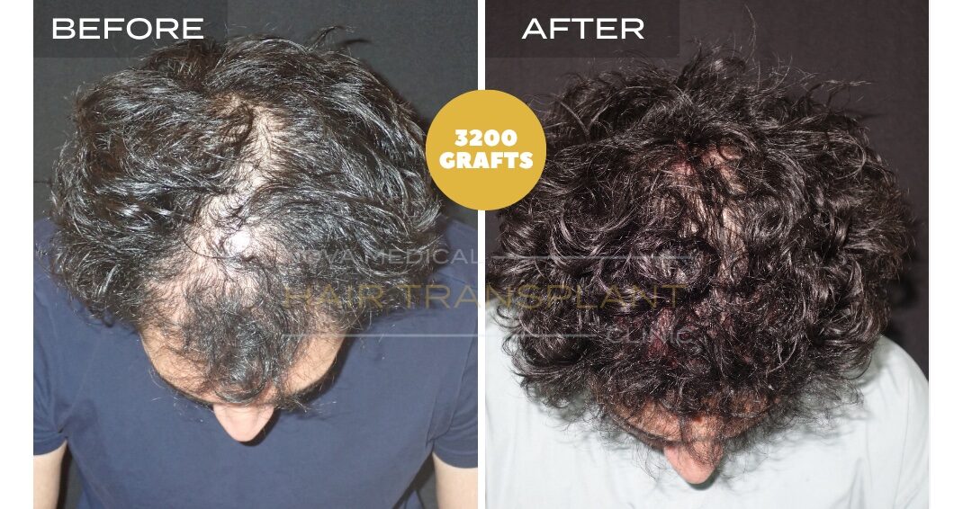 Hair Transplant Before & After Result 26 - DENSITY RESTORATION. MICRO FUE 3200 GRAFTS., Nova Medical Toronto