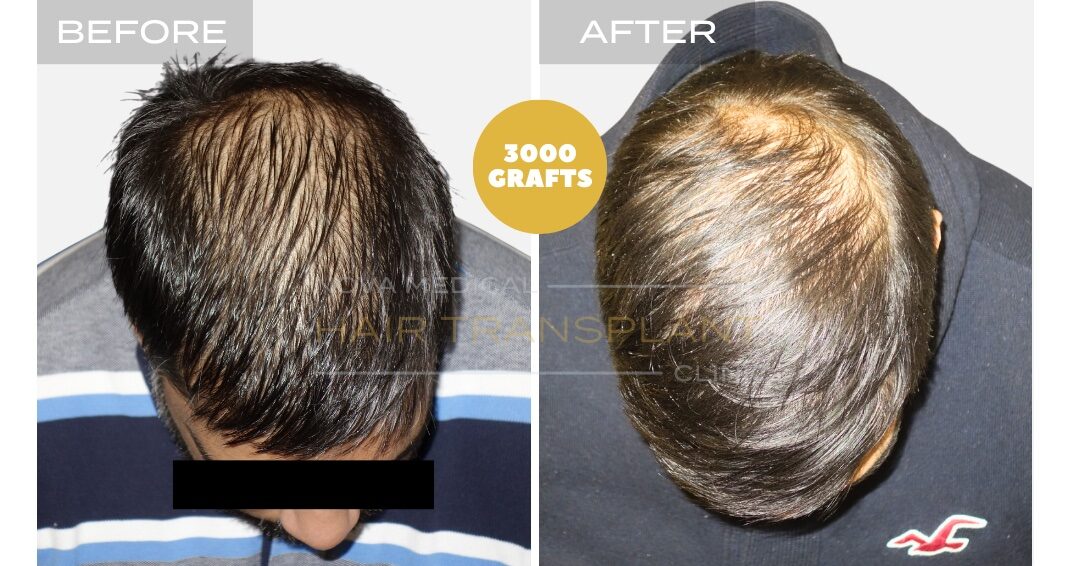Hair Transplant Before & After Result 27 - HAIRLINE + DENSITY RESTORATION. MANUAL FUE 3000 GRAFTS., Nova Medical Toronto