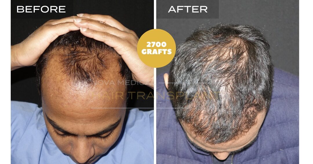 Hair Transplant Before & After Result 28 - HAIRLINE + DENSITY RESTORATION. MANUAL FUE 2700 GRAFTS., Nova Medical Toronto