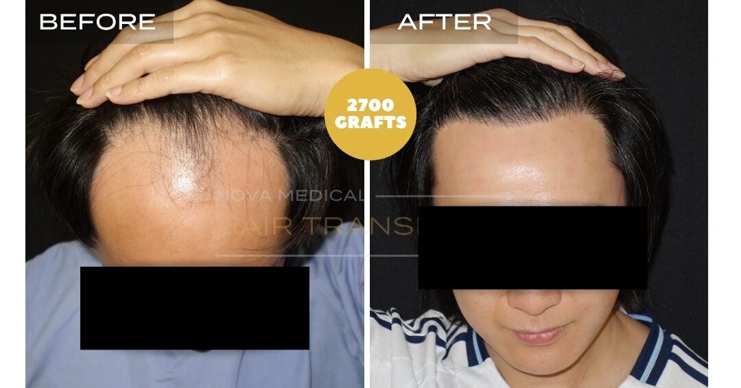 Hair Transplant Before & After Result 29 - HAIRLINE RESTORATION. MANUAL FUE 2700 GRAFTS., Nova Medical Toronto