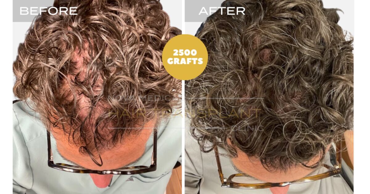 Hair Transplant Video Case Study 1 - SHAVELESS MANUAL FUE 2500 GRAFTS FOR CURLY HAIR. DENSITY FILLING., Nova Medical Toronto
