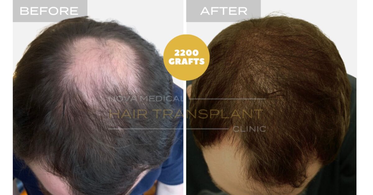 Hair Transplant Video Case Study 2 - CROWN FILLING. MANUAL FUE 2200 GRAFTS + DHI., Nova Medical Toronto