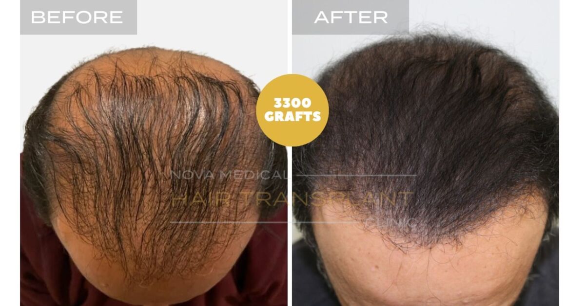 Hair Transplant Video Case Study 3 - LIMITED DONOR AREA. FIXING FACE TO FACE APPEARANCE + DENSITY FILLING, Nova Medical Toronto