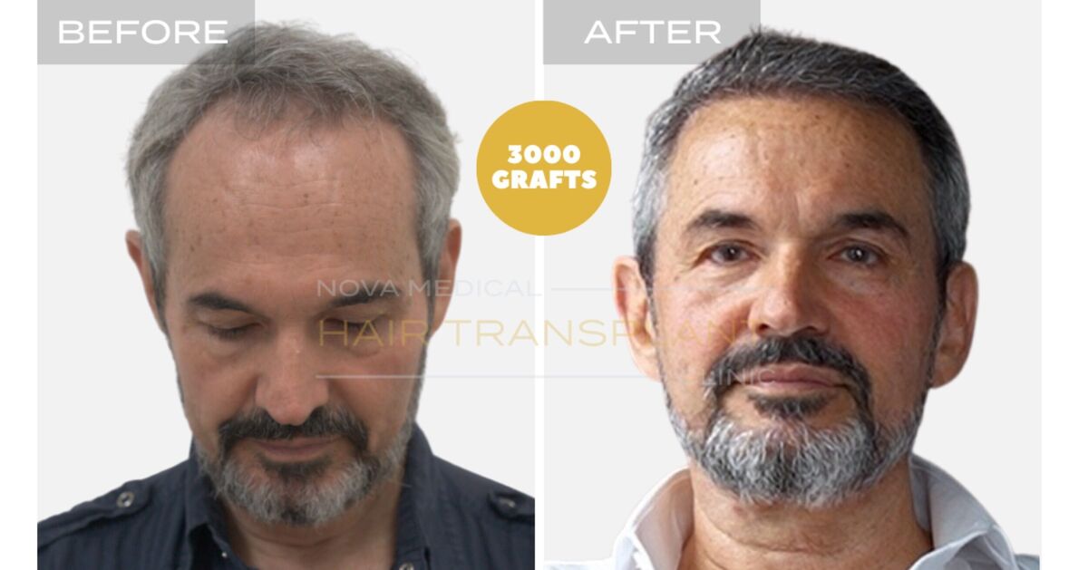 Hair Transplant Video Case Study 4 - HAIRLINE RESTORATION + DENSITY FILLING. MANUAL FUE 3000 GRAFTS., Nova Medical Toronto