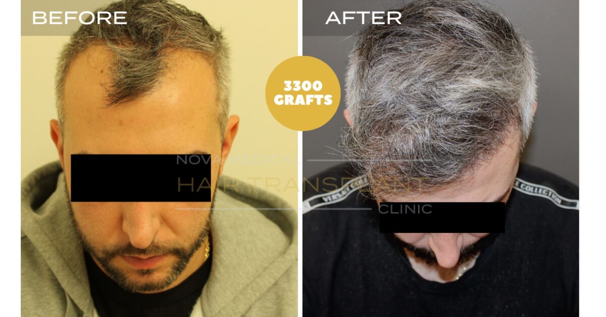 Hair Transplant Video Case Study 5 - HAIRLINE RESTORATION DENSITY FILLING. MANUAL FUE 3300 GRAFTS., Nova Medical Toronto