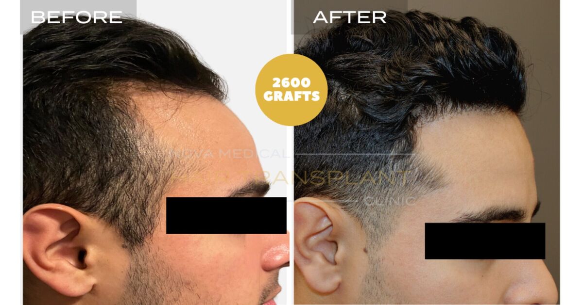 Hair Transplant Video Case Study 6 - TEMPLE FILLING + HAIRLINE RESTORATION. MANUAL FUE 2600 GRAFTS., Nova Medical Toronto