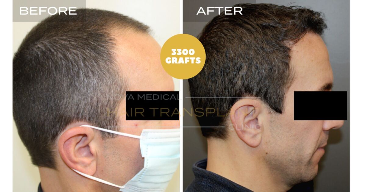 Hair Transplant Video Case Study 7 - TEMPLE FILLING + HAIRLINE RESTORATION. MANUAL FUE 3300 GRAFTS., Nova Medical Toronto