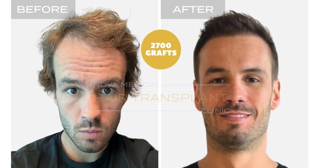 Hair Transplant Before and After - Patient 1, Nova Medical Toronto