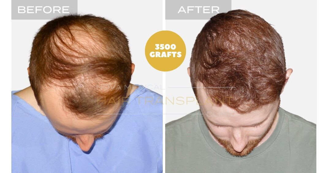 Hair Transplant Before and After - Patient 2, Nova Medical Toronto