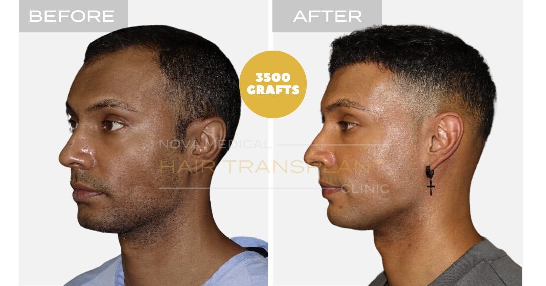 Hair Transplant Before and After - Patient 3, Nova Medical Toronto