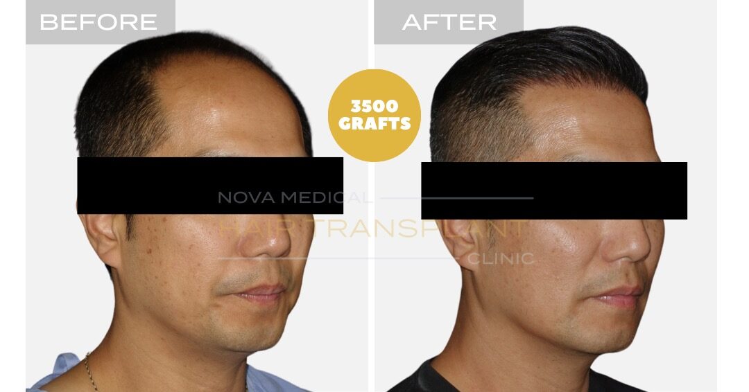 Hair Transplant Before and After - Patient 5, Nova Medical Toronto