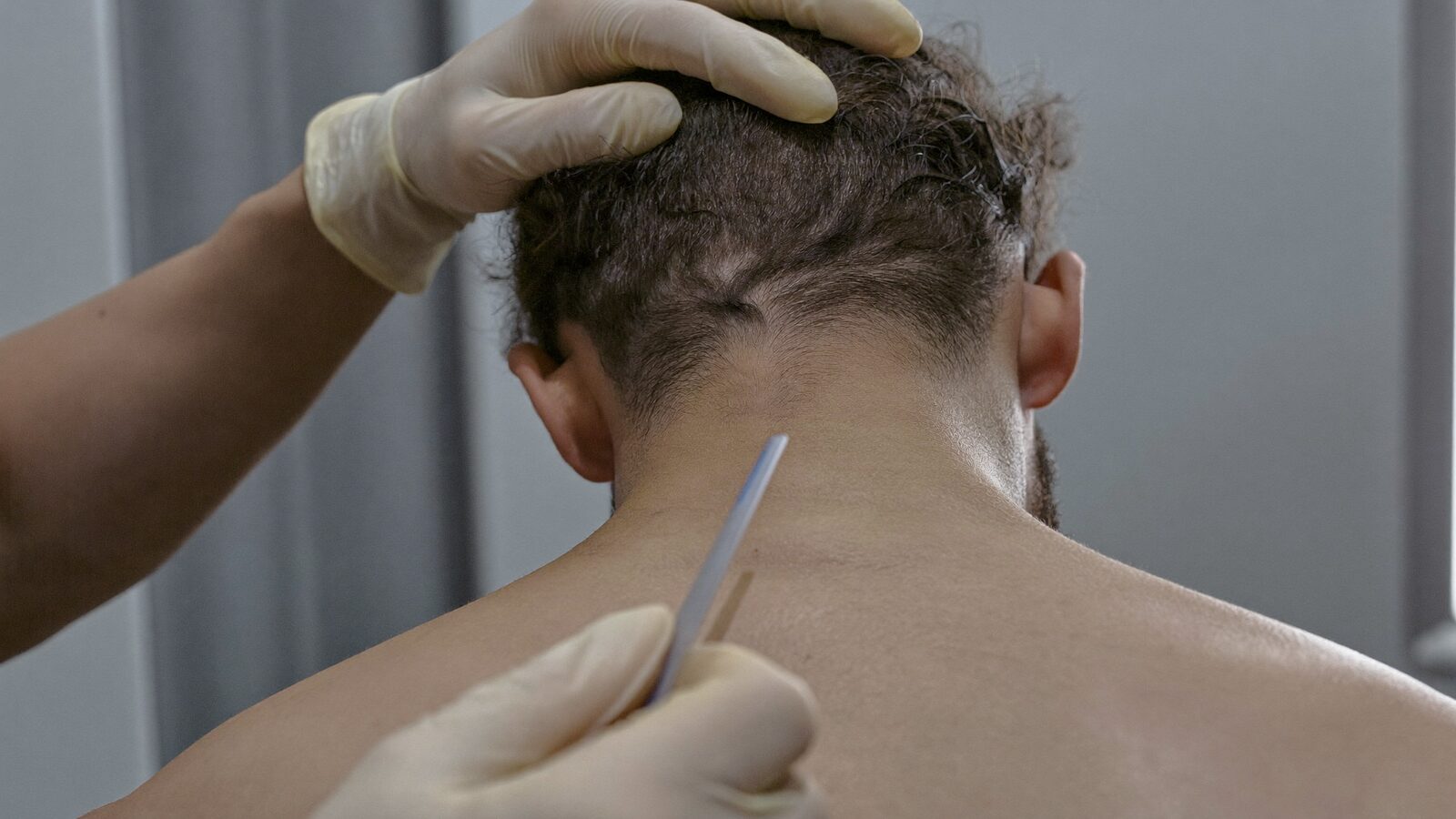 Clinician assessing the donor area at the back of a seated man's head