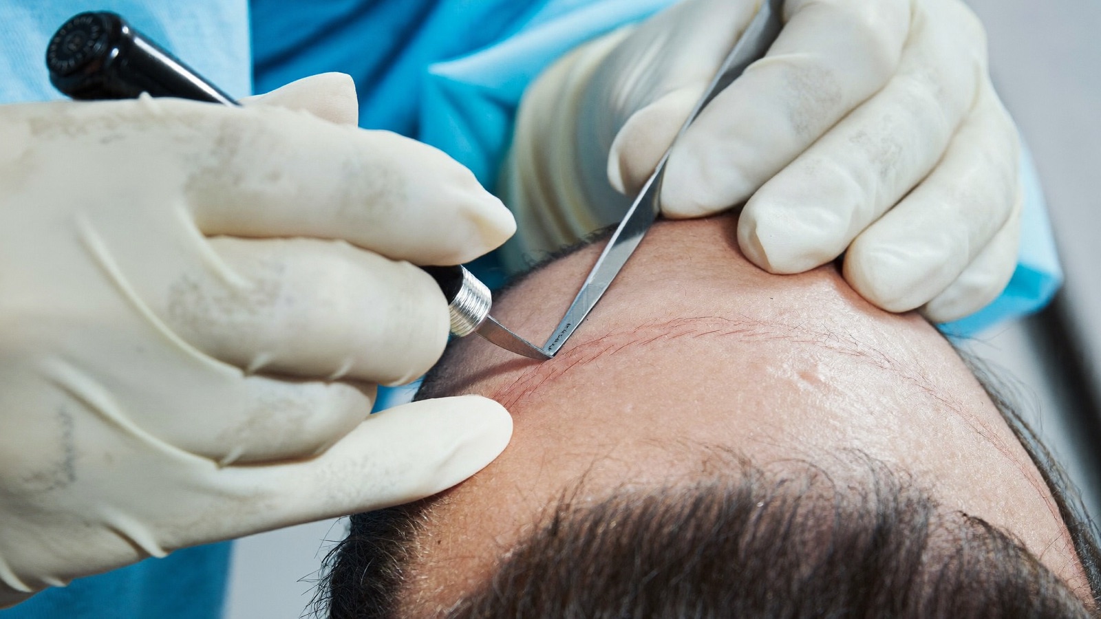 Gloved hands creating fine recipient incisions along a patient's hairline with a small handheld blade