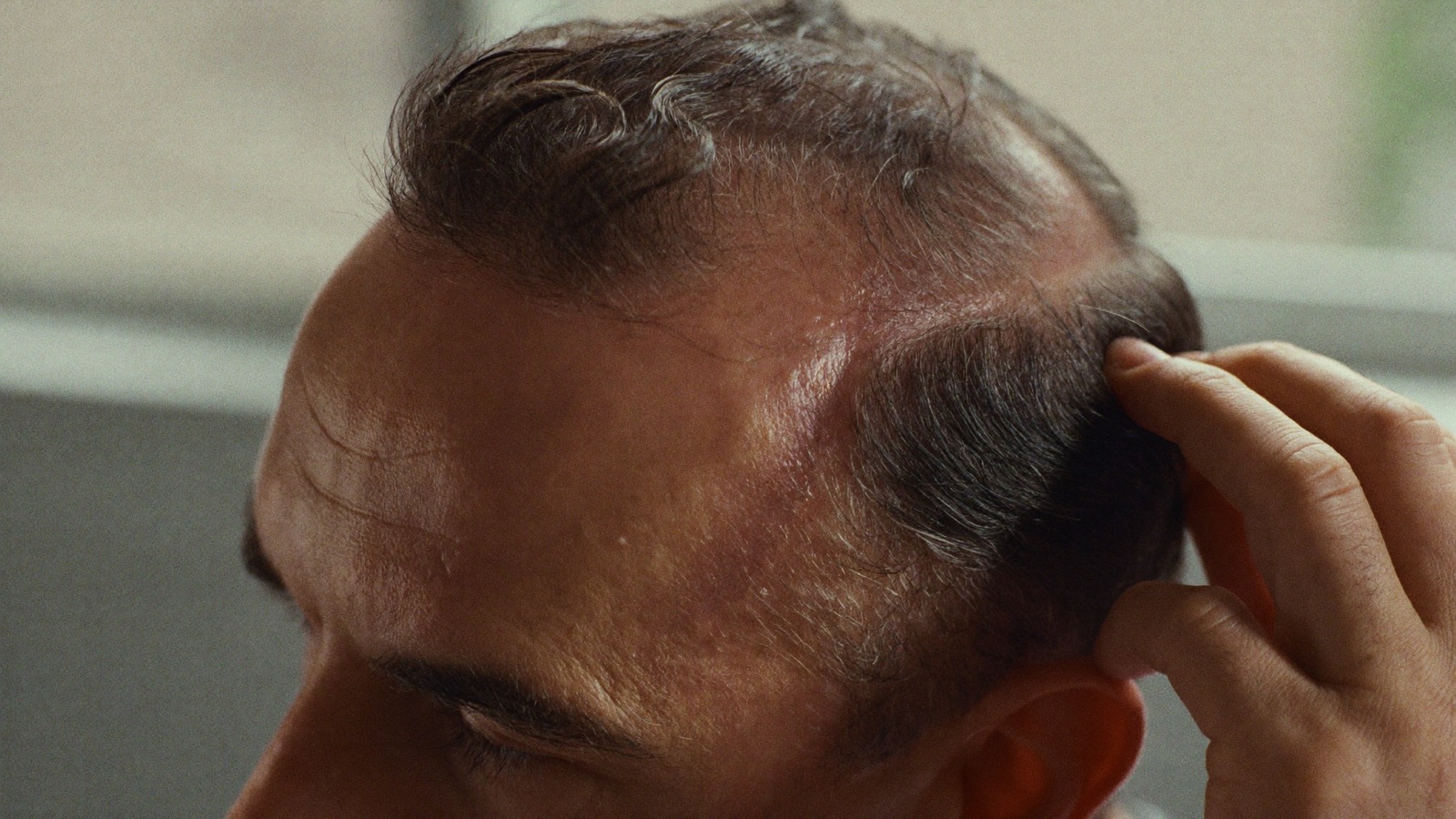 Close view of a man's scalp and hairline during recovery, with his hand lifting the hair at the side